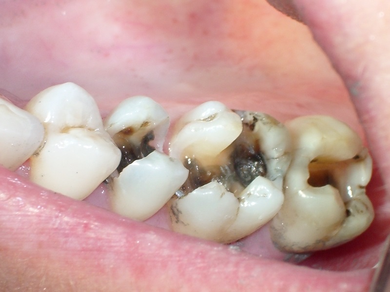 Sâu răng là gì