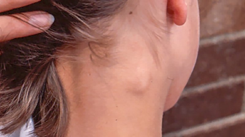 Nổi hạch lympho ở vùng cổ gáy là gì?