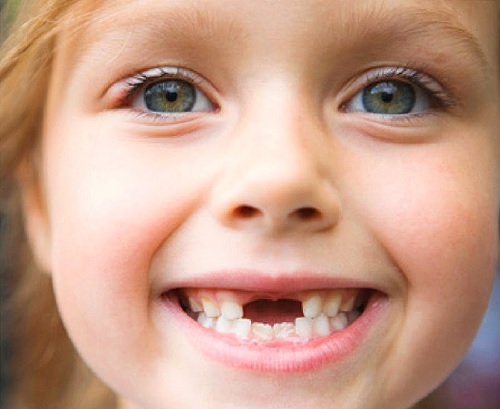 5 mẹo để con có hàm răng đều, không khấp khểnh, hô móm