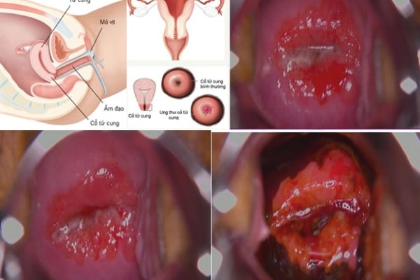 Viêm lộ tuyến cổ tử cung – Nguyên nhân tăng nguy cơ ung thư cổ tử cung