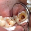 Răng bị thủng lỗ vì sâu răng
