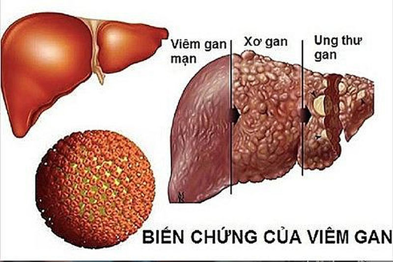 Ung thư gan - căn bệnh ung thư phổ biến tại Việt Nam