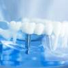 Công nghệ trồng răng Implant là gì? Vì sao nên lựa chọn công nghệ này?