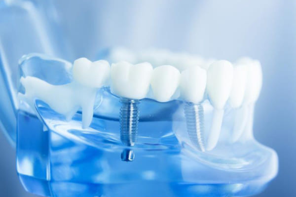 Công nghệ trồng răng Implant là gì? Vì sao nên lựa chọn công nghệ này?