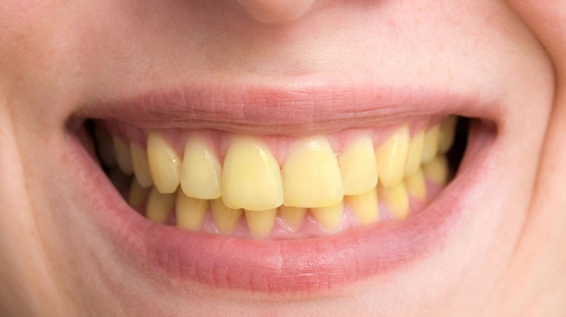 Tẩy trắng răng giúp tự tin khi giao tiếp