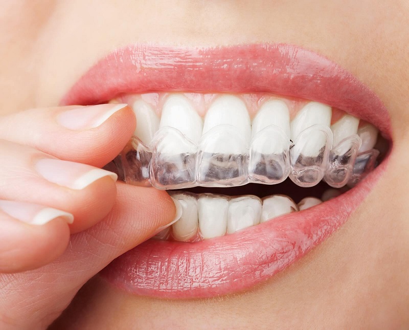Tẩy trắng răng tủy sống bằng máng thuốc
