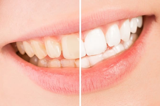 Tẩy trắng răng có phải là giải pháp an toàn?