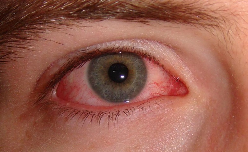 Bệnh đau mắt đỏ có phải là viêm kết mạc không?