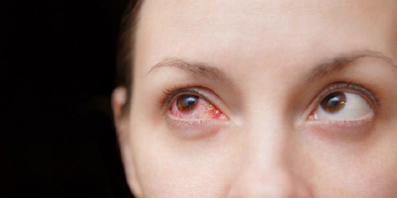 Nguyên nhân gây ra bệnh đau mắt đỏ