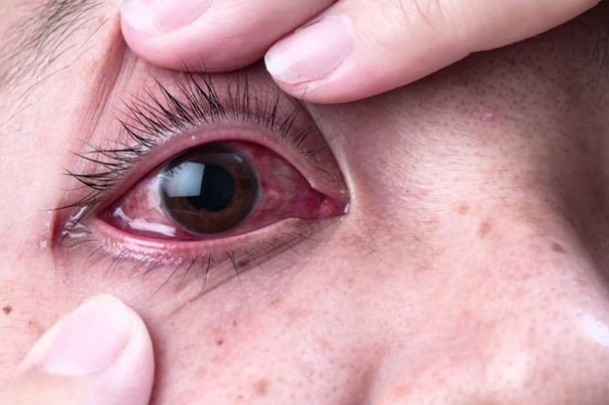 Bệnh đau mắt đỏ do đâu? Bao lâu thì khỏi?
