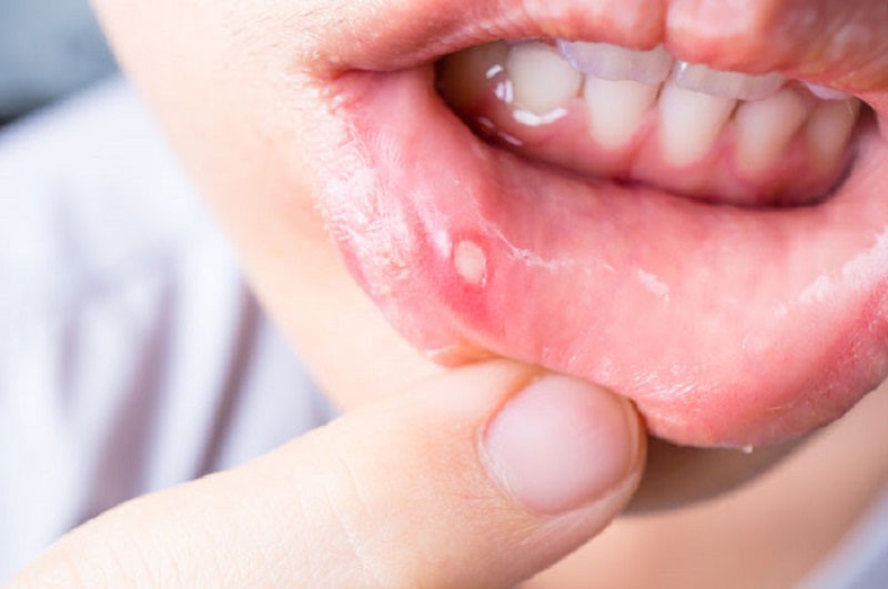 Bệnh nhiệt miệng có nguy hiểm không?