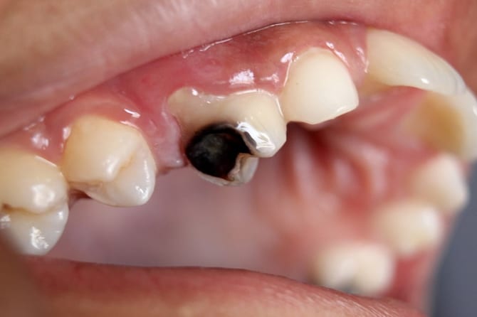 Sâu răng và phương pháp chữa sâu răng hiệu quả