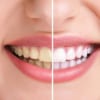 Nguyên nhân gây ra hiện tượng chân răng ố vàng?