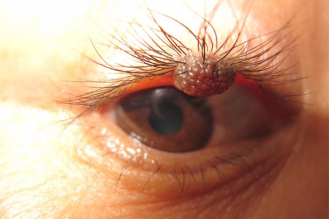 Thành công cắt bỏ u hắc tố mí mắt của bệnh nhân 63 tuổi
