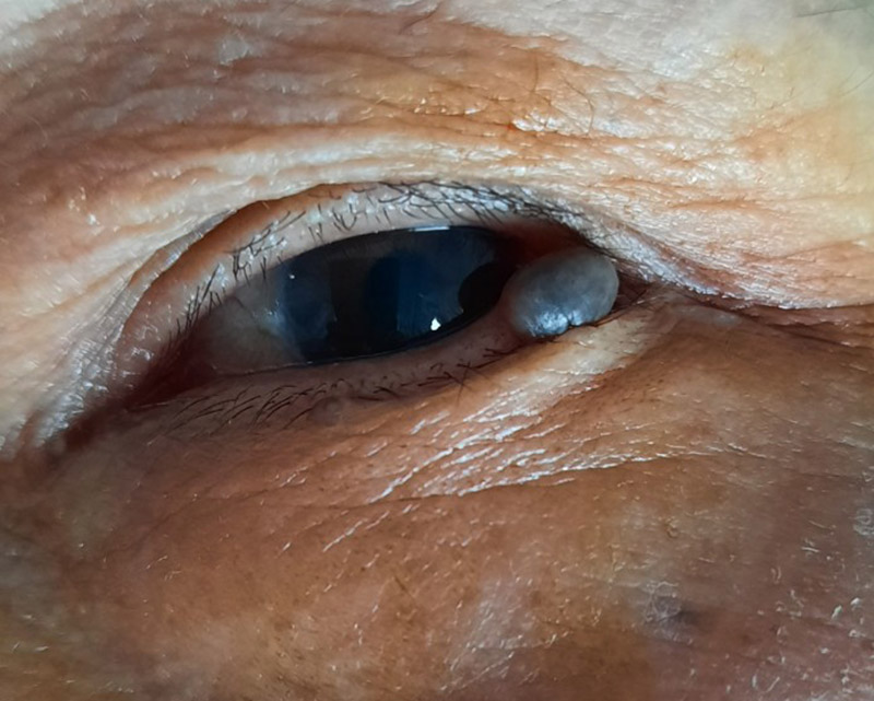 Cắt bỏ u hắc tố mí mắt của bệnh nhân 63 tuổi